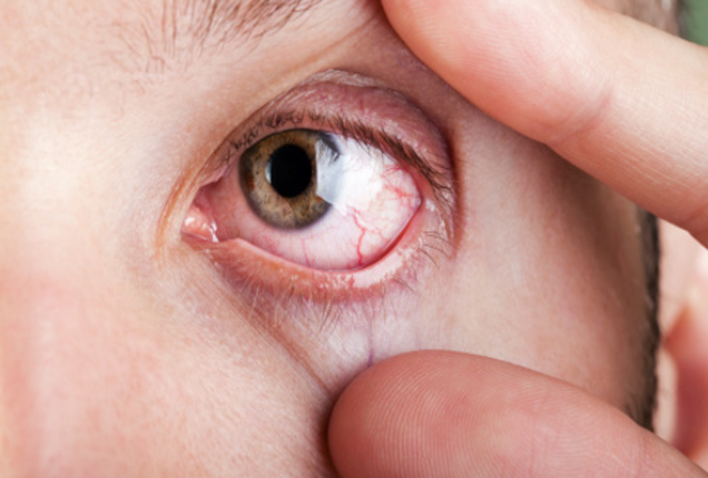 Các nguyên nhân gây tia, gân màu đỏ trong mắt