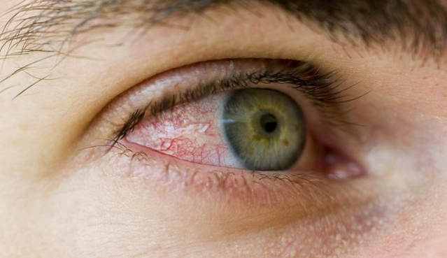 Điều trị tình trạng gân màu đỏ trong mắt